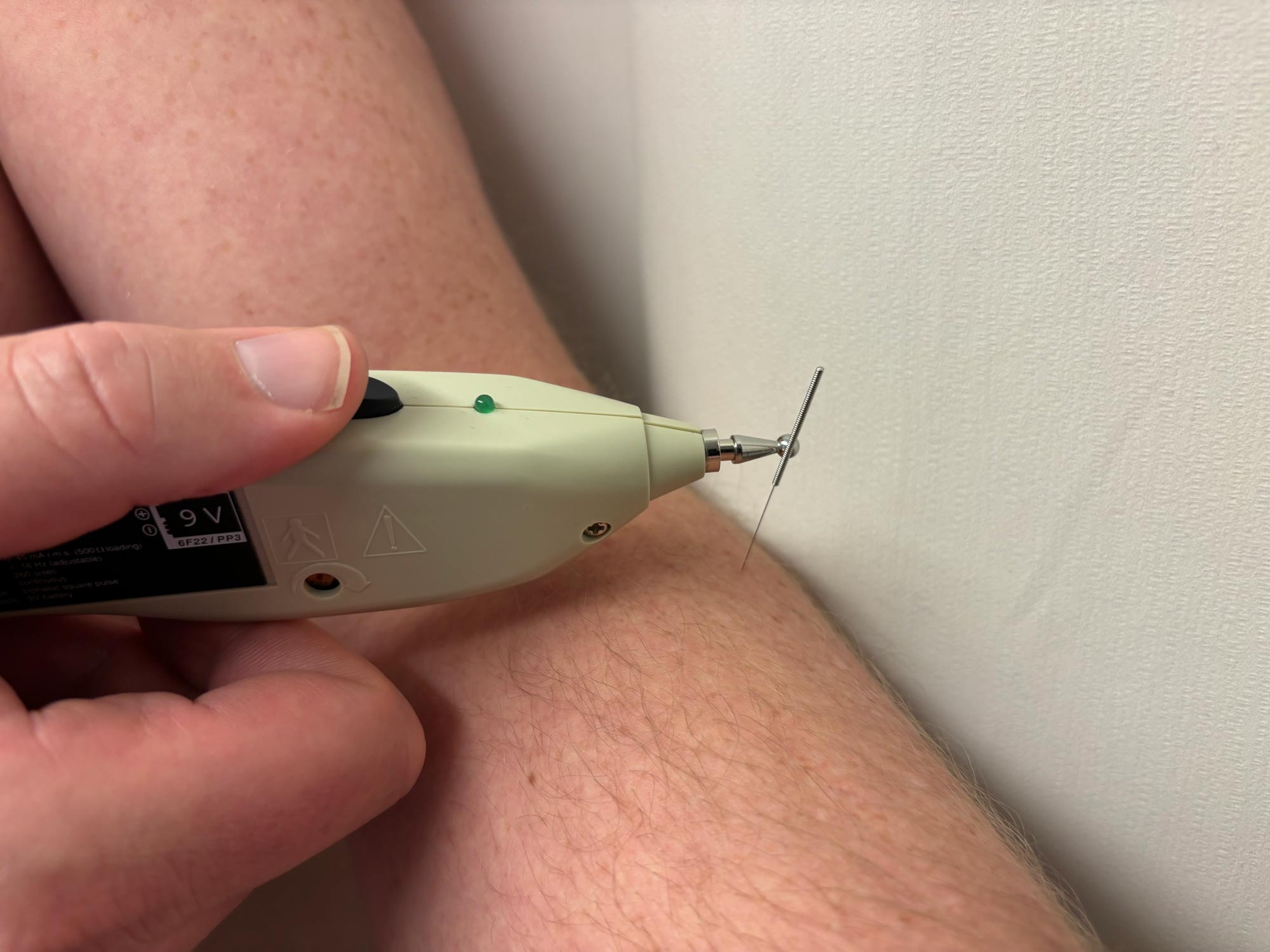 motor joint acupuncture
