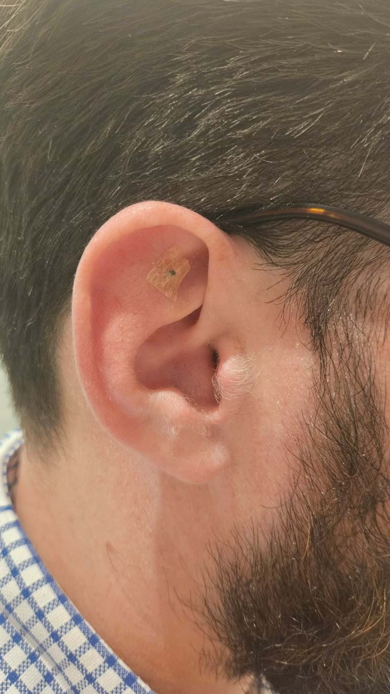 Close-up of an ear with a small bandage, often seen after acupuncture or other TCM treatments.