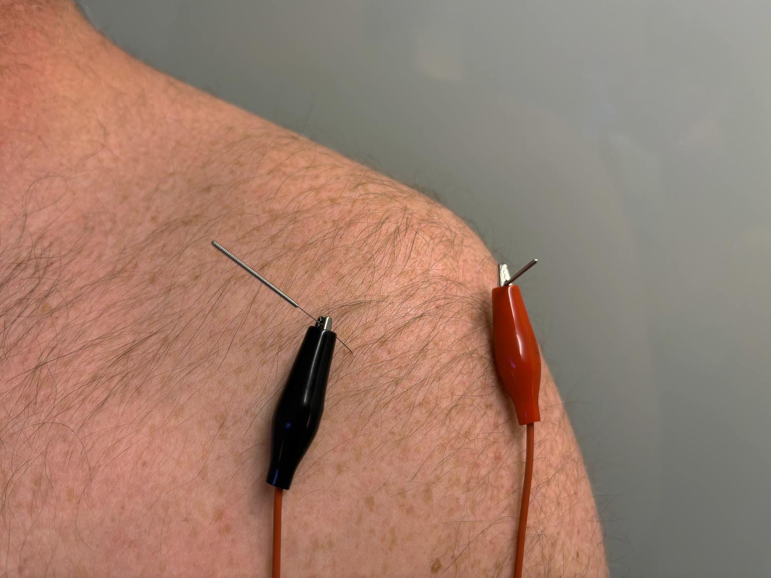 Two acupuncture needles with clips are inserted into the skin of a person's upper shoulder.